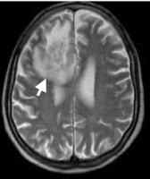 Que es el absceso cerebral, síntomas y diagnóstico
