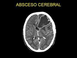 Que es el absceso cerebral, síntomas y diagnóstico