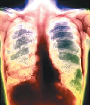 Los pulmones como foco de infección de una tuberculosis
