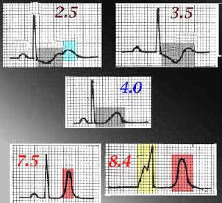 Caso clínico: ¡cuidado con el ECG!