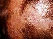 Pérdida cuero cabelludo provocado tiña