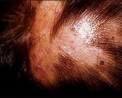 Pérdida del cuero cabelludo provocado por la tiña Pérdida del cuero cabelludo provocado por la tiña