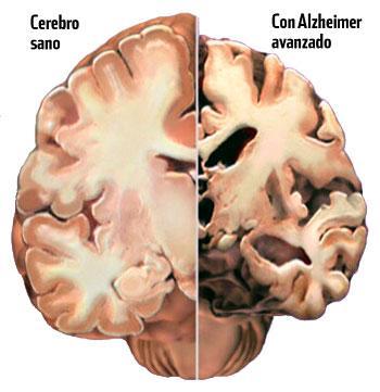 Cerebros inmunes a la enfermedad de alzhéimer Cerebros inmunes a la enfermedad de alzhéimer