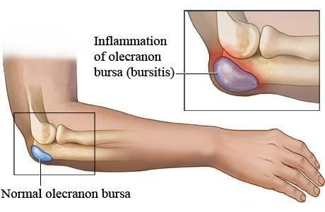Consejos para tratar la bursitis