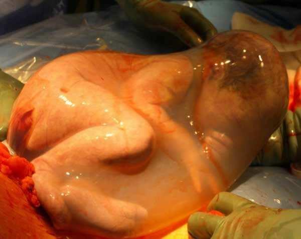 Parto velado: nacimiento de bebés con el saco amniótico intacto