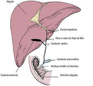 ¿Qué es la atresia biliar extrahepática?