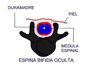 La Raquisquisis o Espina Bífida