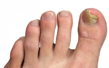 Tratamientos naturales para los hongos en las uñas de los pies