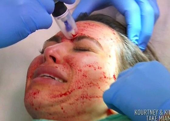 Kim Kardashian llena su rostro de sangre…