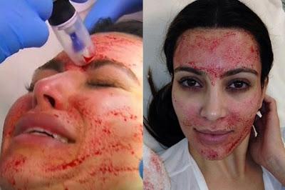Kim Kardashian tratamiento belleza facial vampiro