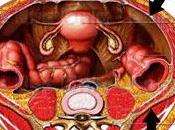 Todo sobre anestesia epidural cesárea