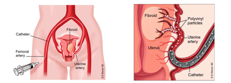 SmartSalus y la embolización Uterina