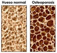 Disminución del calcio en nuestros huesos por la osteoporosis