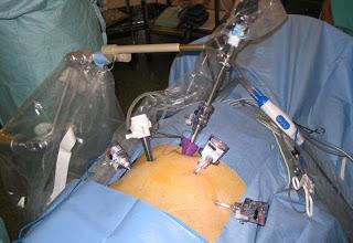 Todo sobre la anestesia en cirugía contra la obesidad: manga gástrica (2)