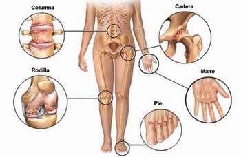Consejos para evitar la artrosis