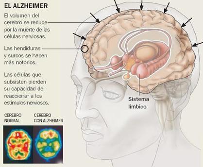Los primeros problemas cognitivos en la enfermedad de Alzheimer