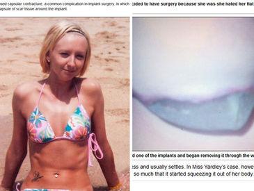 se le sale un implante Contractura capsular