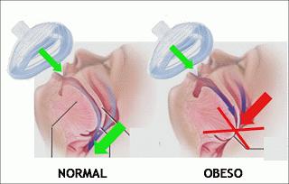 Todo sobre la anestesia en cirugía contra la obesidad: manga gástrica (3)