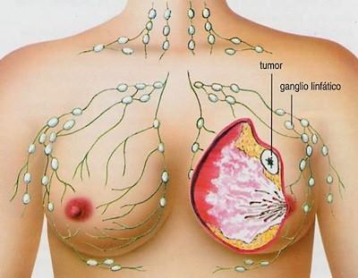 Enlace entre cáncer de mama y diabetes