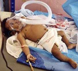 Niño infectado de malaria