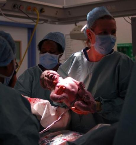 Síndrome de aspiración de meconio SAM