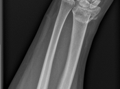 Fractura muñeca