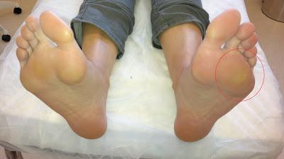 CORRECCION DE UNA METARSALGIA