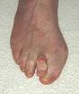 DEFORMIDAD DEDO EN MARTILLO