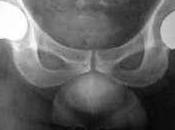 osteoporosis mujer atenúa buena dieta