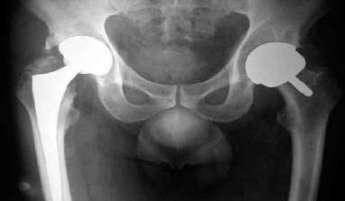 20130325175007-osteoporosis.jpg