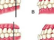 maloclusión, causas, síntomas tratamiento