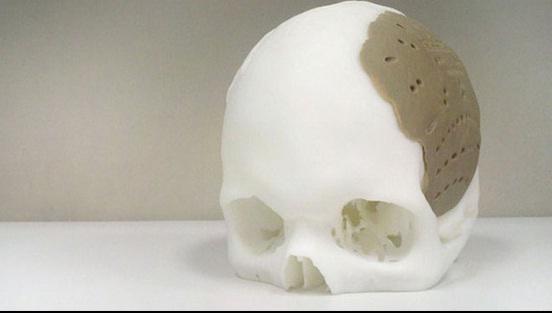 protesis-cranero-impresora-3D