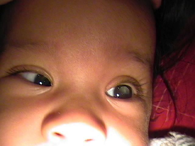 La Retinopatia del Prematuro