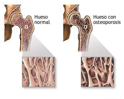 los huesos en la menopausia