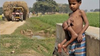 niño con hermano gemelo en el abdomen