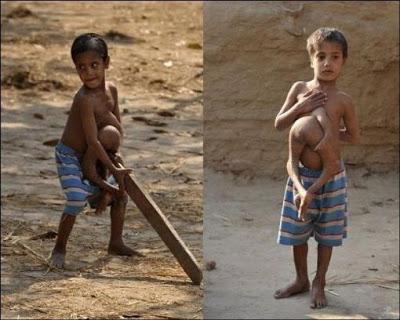 niño con hermano gemelo en el abdomen