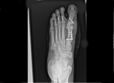 CIRUGIA DE HALLUX VALGUS JUVENIL (JUANETE GRAVE)