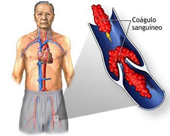 Consejos para prevenir coágulos sanguíneos
