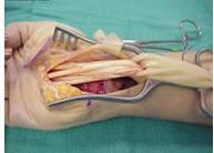 Operación Túnel Carpiano Operacion tunel carpiano