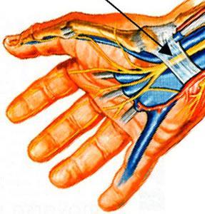 Sindrome del Tunel Carpiano Sindrome del Tunel del Carpo