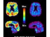 Deposito amiloide, neurodegeneración deterioro cognitivo enfermedad Alzheimer esporádica: estudio cohorte prospectivo.
