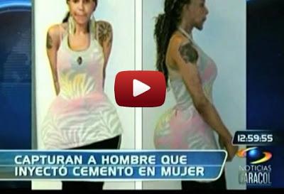 VIDEO - Doctor le inyectan cemento en sus gluteos a esta mujer.