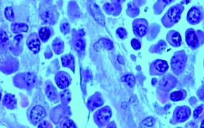 Conociendo el mieloma múltiple. Hacia la mejora de los pronósticos