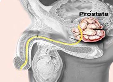 Cómo prevenir el cáncer de próstata