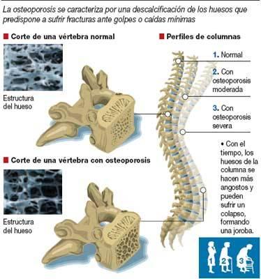 descalsificacion osea