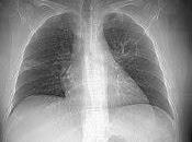 pone marcha Wikipedia pulmonar