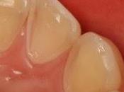 ☻¿como prevenir erosión dental?