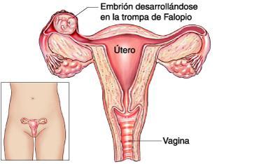 En qué consiste el embarazo ectópico