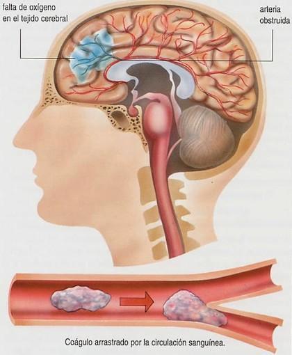 Encefalitis. Causas y prevención Encefalitis. Causas y prevención