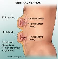 Qué es una hernia, porque hay que operar, cuánto dura la intervención